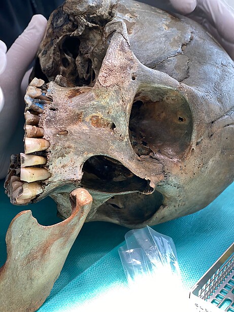 Operation in der Oralchirurgie Praxis Schumann & Rolfsen